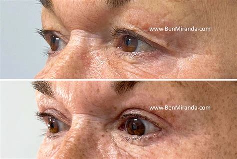 Blepharoplasty, Eyelid Reduction Surgery: London & Essex