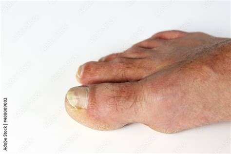 Close up fungus toenail disease, the fungus infects the areas between ...