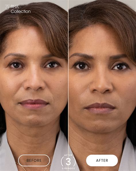 Best Facial Wrinkles Treatments to Try in 2024, According to Experts ...