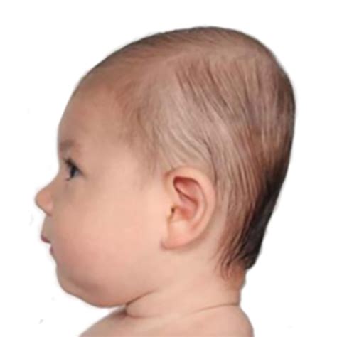 flat head syndrome  rockaway times