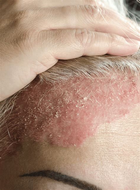 Psoriasis | Thomson Medical