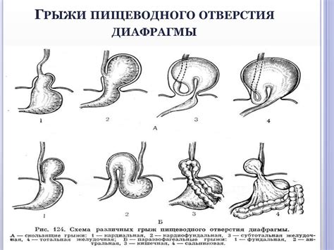 Грыжи пищеводного отверстия диафрагмы - презентация онлайн
