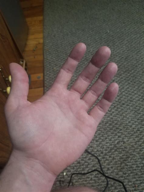 Hands very splotchy. Liver pain as well. Ultrasound 4 months ago said