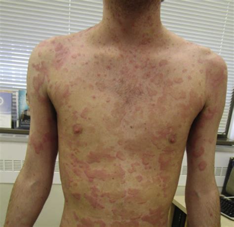 A case of eosinophilic annular erythema as a presenting sign for ...