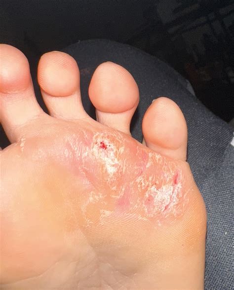 Is my plantar wart situation healing? I’ve been using the compound SA
