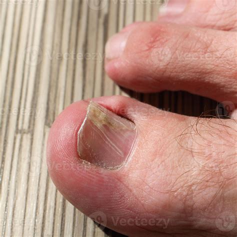 Damaged toenail. The problem with the nail 50375821 Stock Photo at Vecteezy