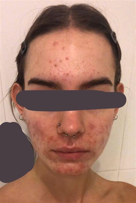 3 Month Progress on 10mg Isotret. : r/Accutane