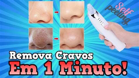 Como Tirar Cravos Profundos - Como Remover Cravos Em 1 Minuto Com Esse Aparelho Milagroso - YouTube