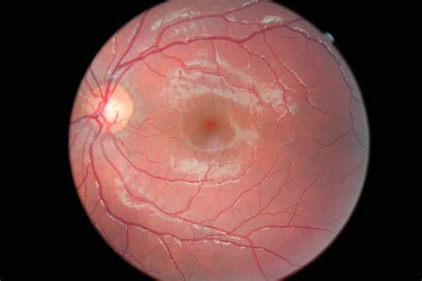 Laser Beam Damage Eyes - The Best Picture Of Beam