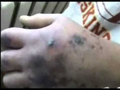 Russian Krokodil drugs - YouTube