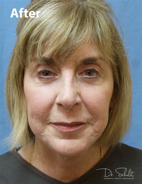 Face & Neck Lift 26 - Dr. Schalit Cosmetic Facial Specialist