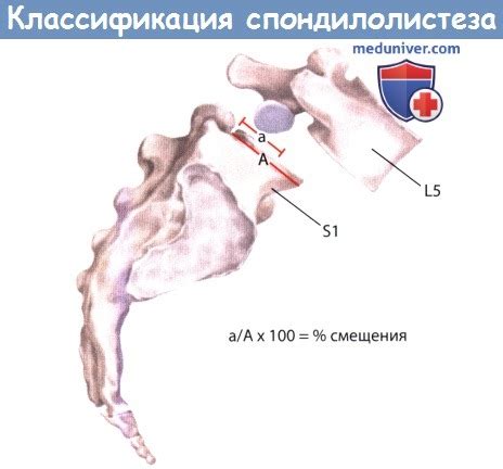 Варианты и техника операции при спондилолистезе (соскальзывании позвонка)