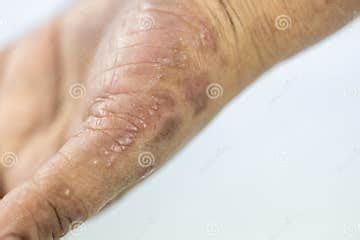 Atopic Dermatitis and Fungal Diseases on the Human Body. Stock Photo ...