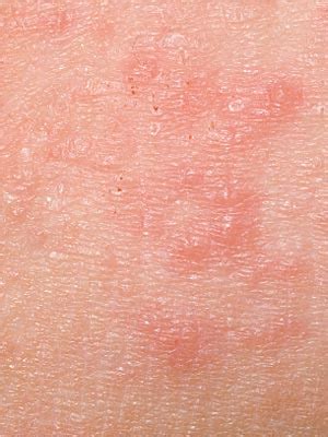 herpetic dermatitis - pictures, photos