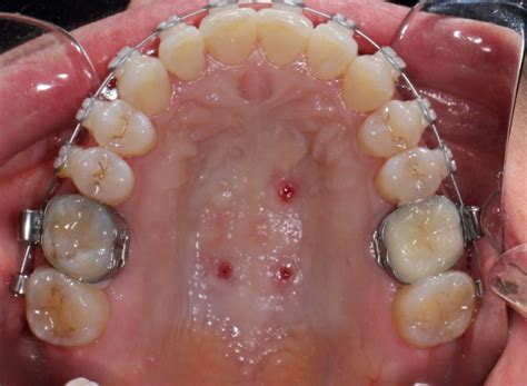 Maxillary Skeletal Expander (MSE) - Lemke Orthodontics | Sugar Land ...