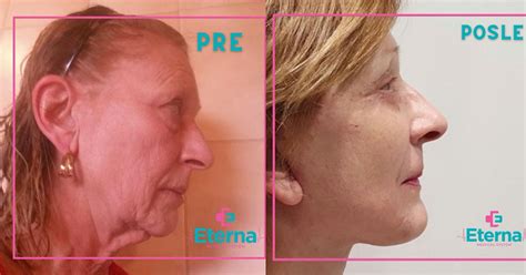 Lifting lica - Eterna Medical System & Hospital