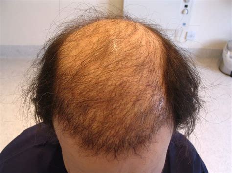 completely bald hair transplant     wimpole clinic