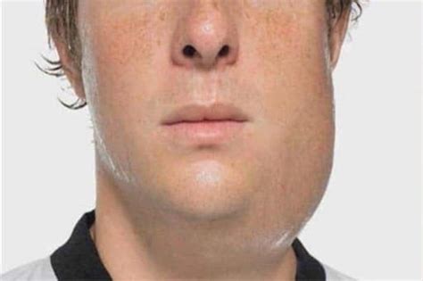 Pescoço Inchado Do Lado Esquerdo - Inchaço no Pescoço: causas e o que fazer