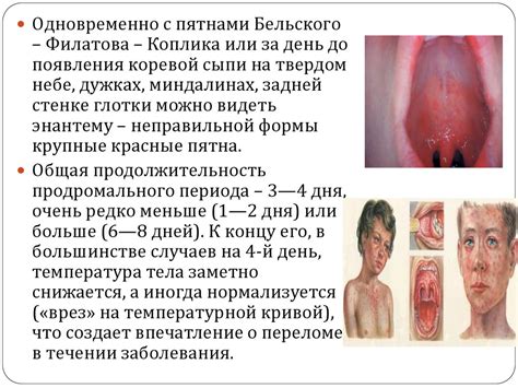 Корь - презентация онлайн