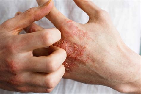 10+ Ways How to Treat Eczema: Causes, Types and Natural Remedies