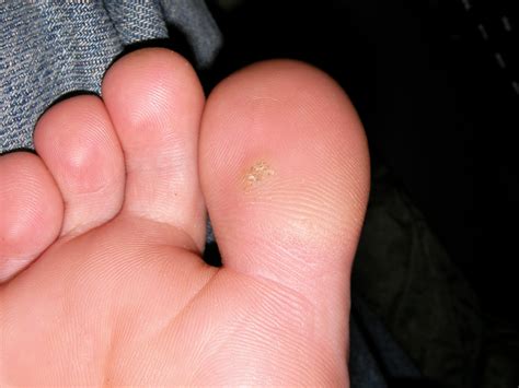 Corn Callus Vs Wart at Duane Stokes blog