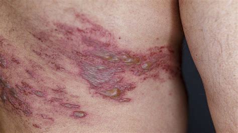Shingles