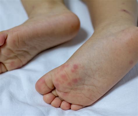 Doenca Mao Pé Boca - Síndrome Mão-Pé-Boca: Amazonas alerta sobre doença viral que causa ...