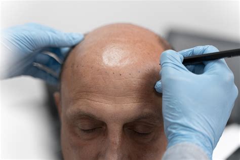 What Is Scalp Micropigmentation in 8 Titles? - WestModern Clinic