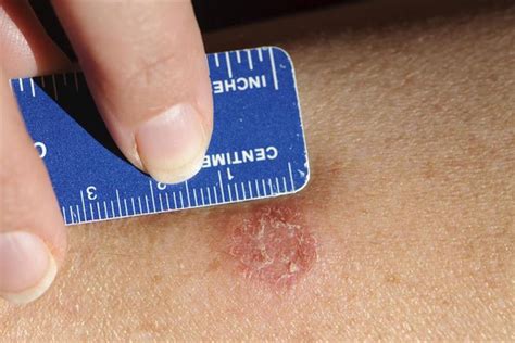 Fungal infections of the skin