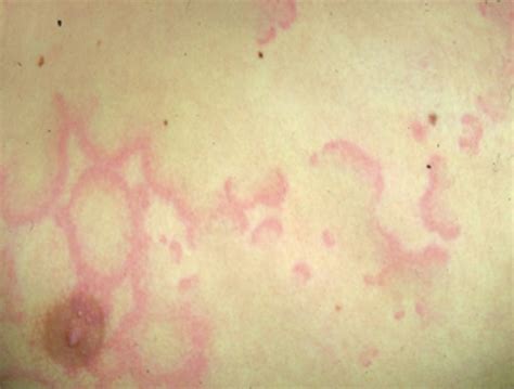 imageerythema marginatum msd manual consumer version