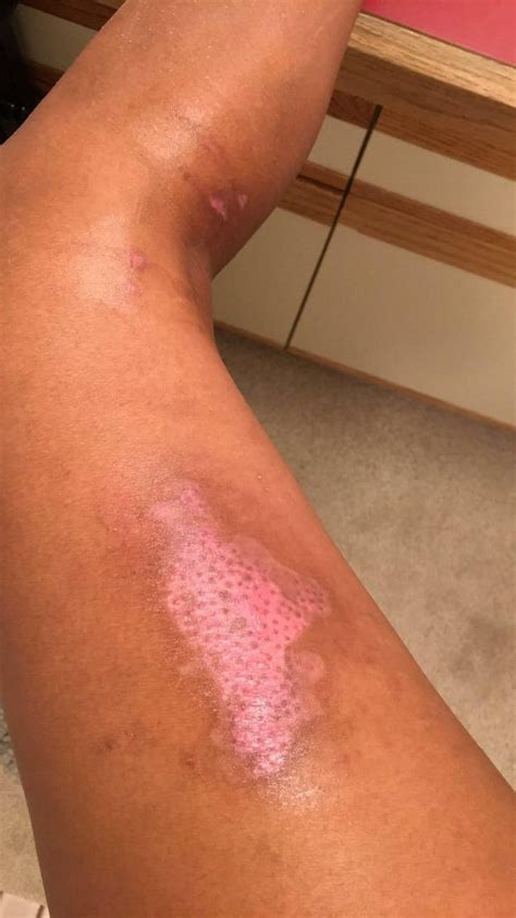 Second degree burn : r/MedicalGore