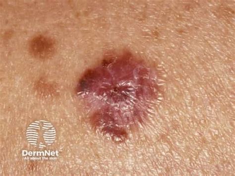 Images of Amelanotic Melanoma — DermNet