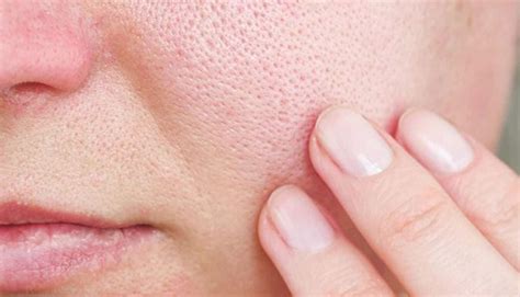Nguyên nhân và cách điều trị lỗ chân lông to - MỸ PHẨM ĐÔNG Y KOREAN