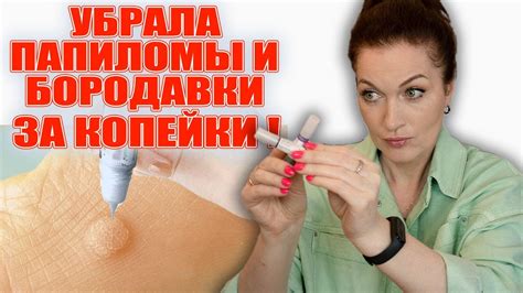 Избавилась от бородавок и папиллом за копейки! - YouTube