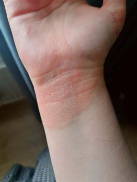 Hand eczema healing!! : r/eczema