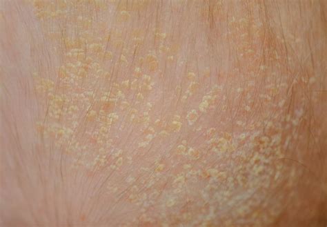 psoriasis  seborrheic dermatitis     difference