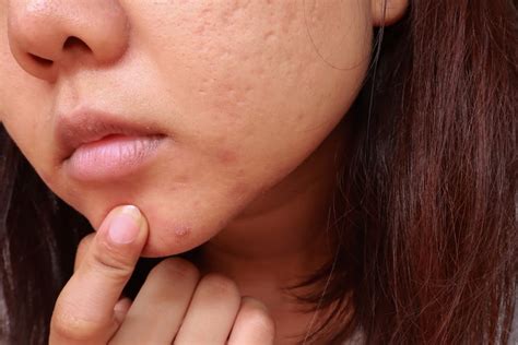 Blackheads: Removal, Treatments, and Tips | POPSUGAR Beauty