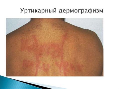 Визуальная диагностика дерматитов (контактно-аллергический, атопический ...