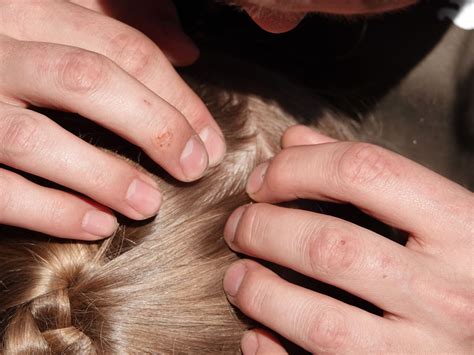 How To Stop Ingrown Hairs On Back Of Head - Infoupdate Wallpaper Images