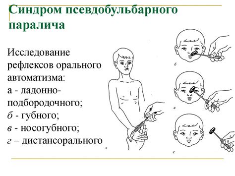Синдромы поражения черепно-мозговых нервов - презентация онлайн