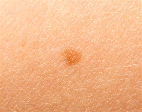 Epidermális nevus Stock Photos, Royalty Free Epidermális nevus Images ...