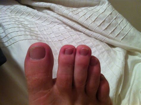 Home Treatment For Hammer Toes - Velvet Fuhriman