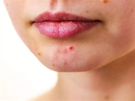 Breaking Out Around Your Mouth? Here is Why am I breaking out around m ...
