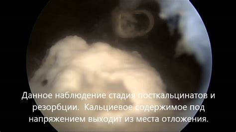 Артроскопия плечевого сустава, кальцинирующий тендинит. - YouTube