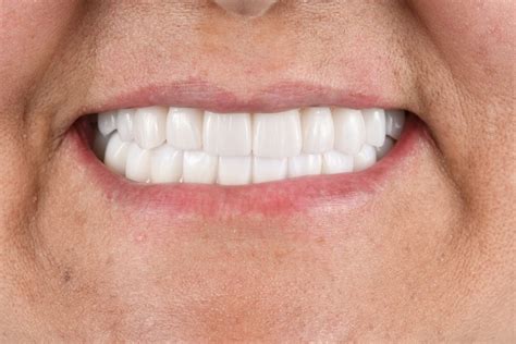 Veneers to Fix Tooth Imperfections - Plainview Dental Plainview New York