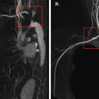 hypotrophy    thenar muscle  scientific diagram