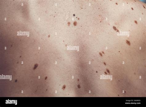 A melanocytic nevus also known as nevocytic or nevus-cell nevus and ...