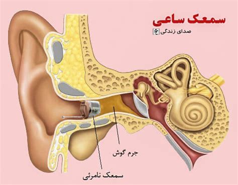 انواع سمعک نامرئی (IIC) | قیمت سمعک نامرئی -کلینیک سمعک ساعی