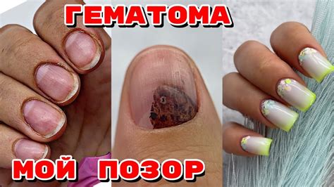 ГЕМАТОМА НА НОГТЕ 😥 СДЕЛАЛА ДЫРКУ 😐 Наращивание гелевыми типсами 💅 ...