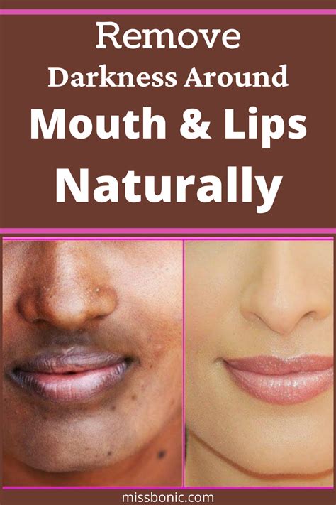 remove darkness  mouth  lips naturally darkness  mouth